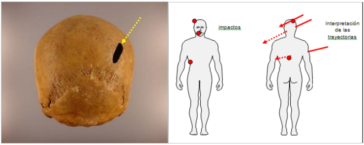 Perforaci&oacute;n por impacto tangencial de proyectil de arma de fuego (Individuo 1).Interpretaci&oacute;n de las trayectorias de tres impactos de arma de fuego. Kurtzetxiki (Gipuzkoa).