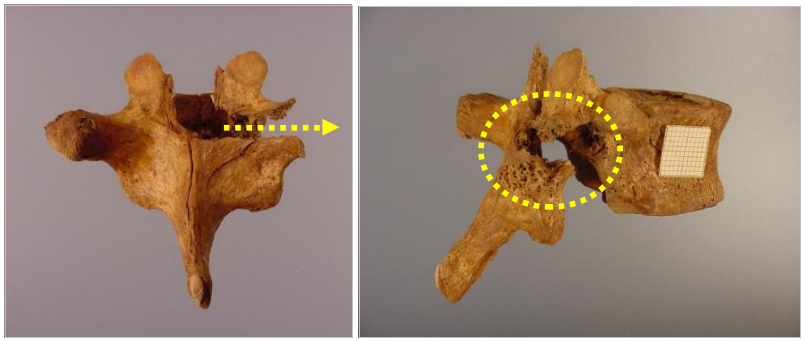 V&eacute;rtebra dorsal con lesi&oacute;n perforante por el paso de un proyectil de arma de fuego. Kurtzetxiki (Gipuzkoa).