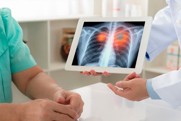 Imagen diagn&oacute;tico c&aacute;ncer de pulm&oacute;n