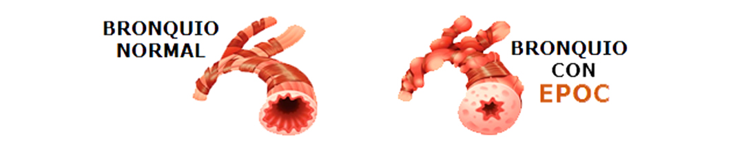 Bronkios con Epoc y sin EPOC