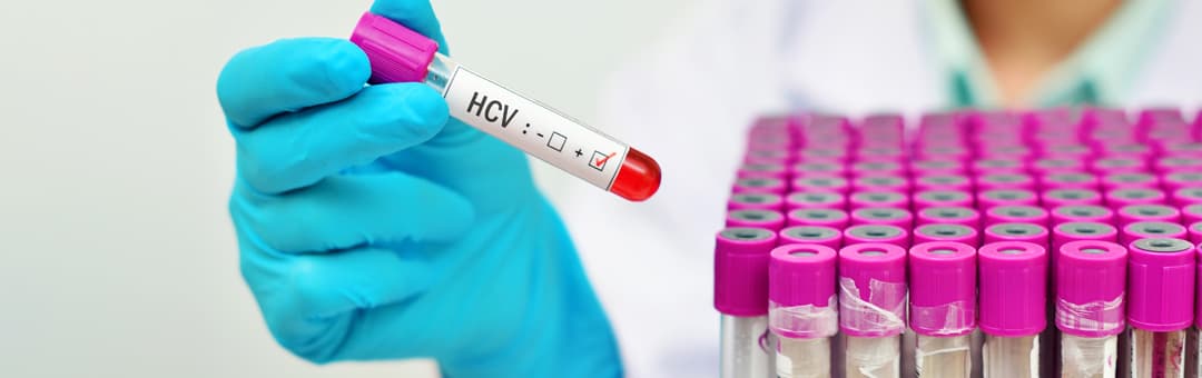 Pruebas de la hepatitis c