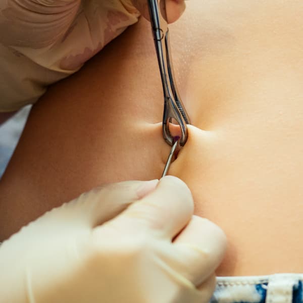 C hepatitisa prebentzioa