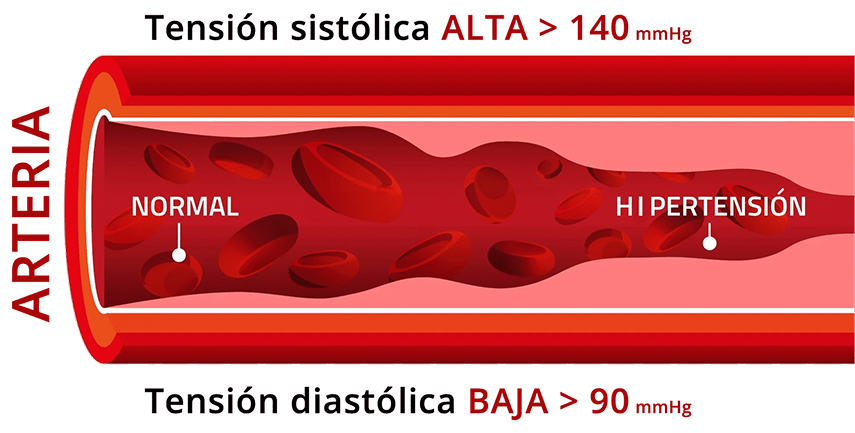 Imagen arteria con hipertensión