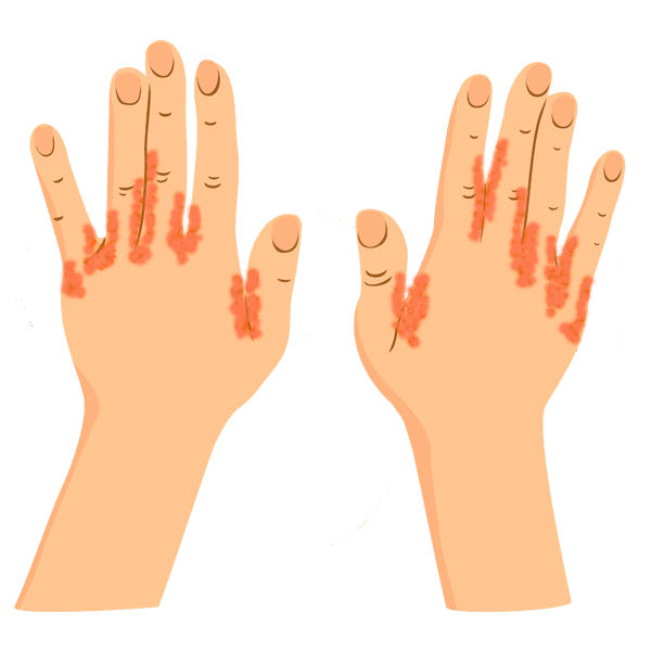 Eskuak sarna urtikariarekin