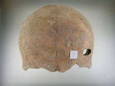 Región frontal de cráneo con perforación en el lado izquierdo por impacto de proyectil de arma de fuego.